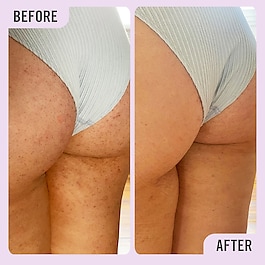 KP Bump Eraser Body Scrub with 10% AHA - Körper-Peeling mit AHAs